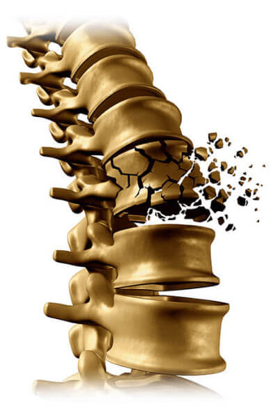 Spine Fracture