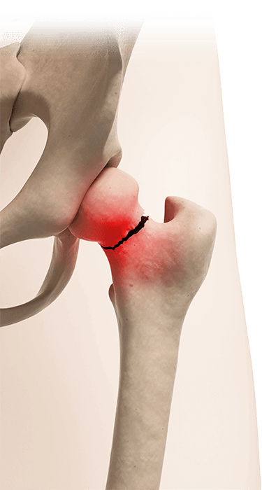 Broken hip